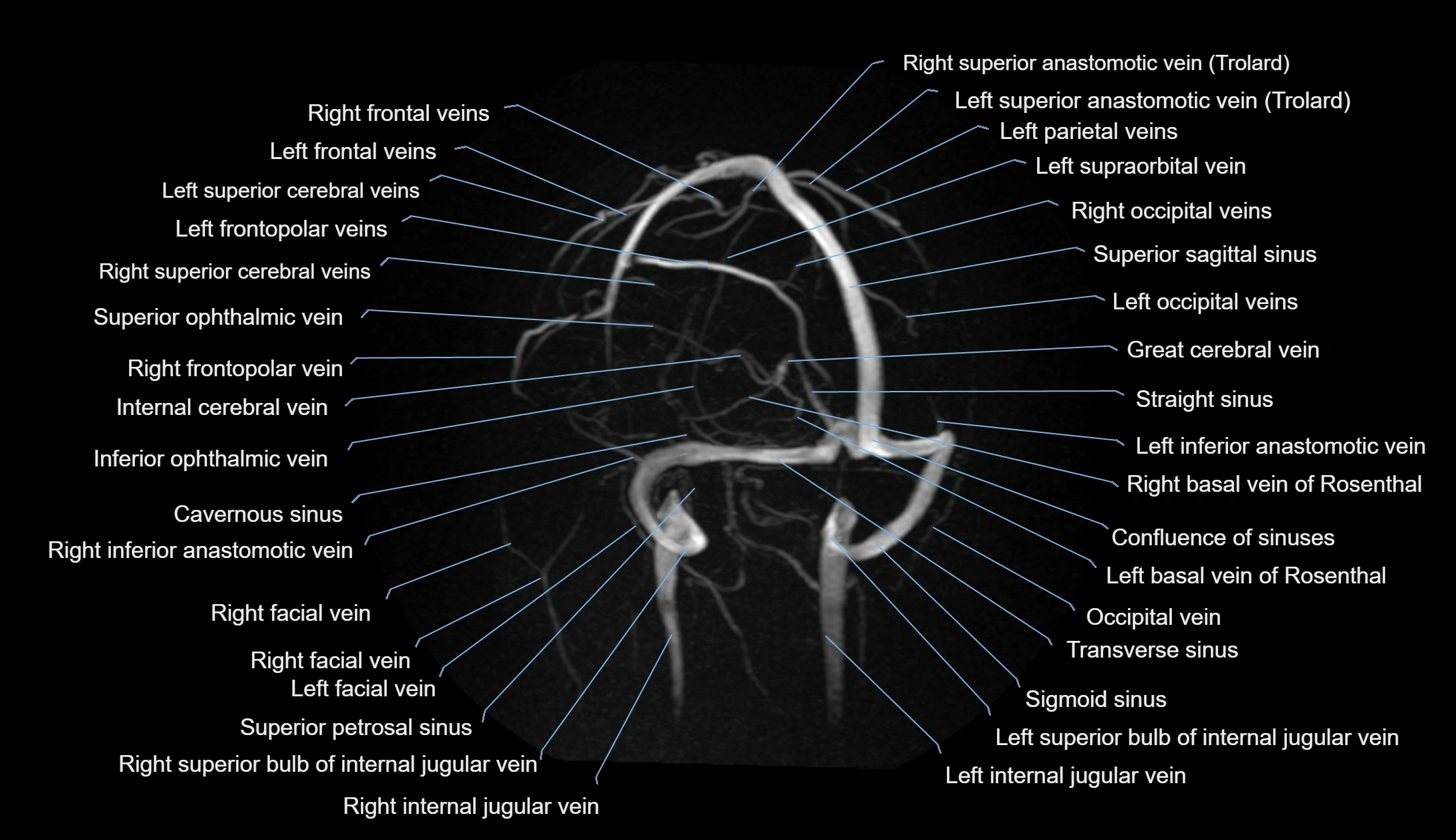 MRV brain MIP sagittal labelled anatomy 3T MRI images -img-1011001-00003.webp
